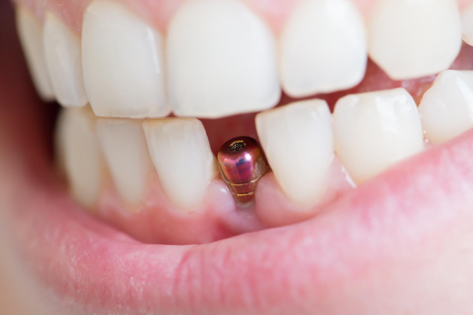 Implant dentaire : peut-on en poser plusieurs au même temps ?