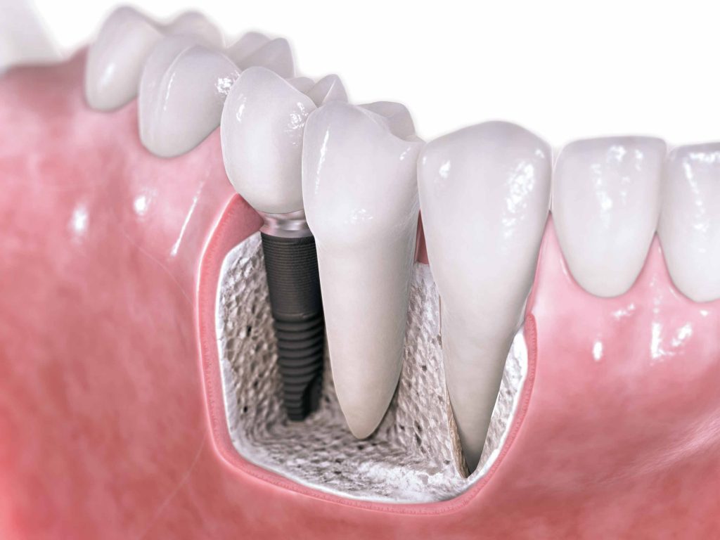 Implant dentaire : une dent artificielle fiable ?